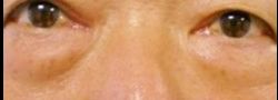 Lower Eyelid Blepharoplasty case #10815