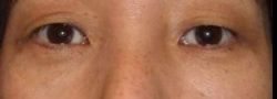 Lower Eyelid Blepharoplasty case #10812