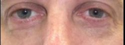 Lower Eyelid Blepharoplasty case #10803