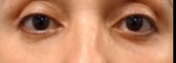 Lower Eyelid Blepharoplasty case #10799