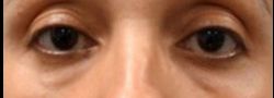 Lower Eyelid Blepharoplasty case #10799