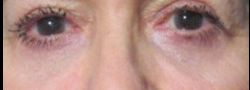 Lower Eyelid Blepharoplasty case #10796