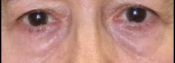 Lower Eyelid Blepharoplasty case #10796