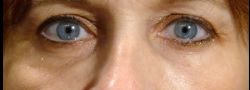 Lower Eyelid Blepharoplasty case #10793