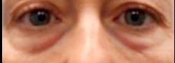 Lower Eyelid Blepharoplasty case #10790