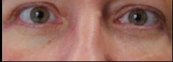 Lower Eyelid Blepharoplasty case #10787