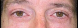 Lower Eyelid Blepharoplasty case #10783