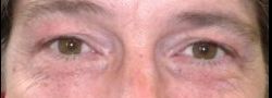 Lower Eyelid Blepharoplasty case #10783