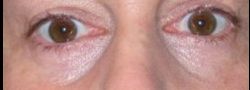 Lower Eyelid Blepharoplasty case #10780