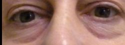 Lower Eyelid Blepharoplasty case #10780