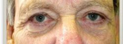Lower Eyelid Blepharoplasty case #10777