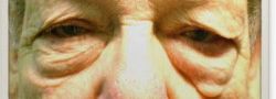 Lower Eyelid Blepharoplasty case #10777