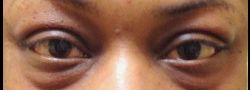 Lower Eyelid Blepharoplasty case #10774