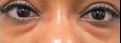 Lower Eyelid Blepharoplasty case #10771