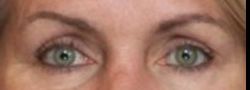 Dr. Lee’s Brow Lift case #10682