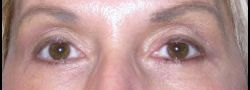 Dr. Lee’s Brow Lift case #10679