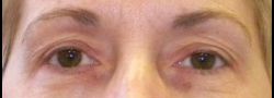 Dr. Lee’s Brow Lift case #10679