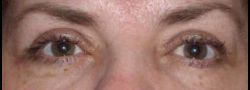 Dr. Lee’s Brow Lift case #10676