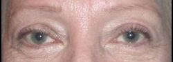 Dr. Lee’s Brow Lift case #10673
