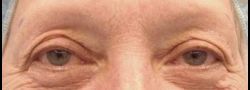 Dr. Lee’s Brow Lift case #10673