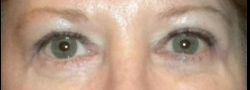 Dr. Lee’s Brow Lift case #10670