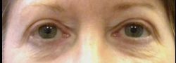 Dr. Lee’s Brow Lift case #10670