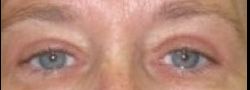 Dr. Lee’s Brow Lift case #10667