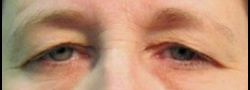 Dr. Lee’s Brow Lift case #10667