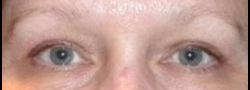 Dr. Lee’s Brow Lift case #10661