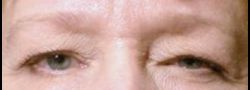 Dr. Lee’s Brow Lift case #10661