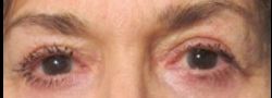 Dr. Lee’s Brow Lift case #10658