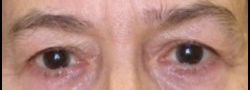 Dr. Lee’s Brow Lift case #10658
