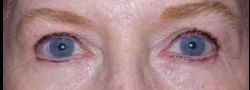 Dr. Lee’s Brow Lift case #10655