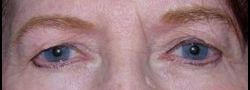 Dr. Lee’s Brow Lift case #10655