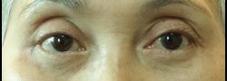 Dr. Lee’s Brow Lift case #10649