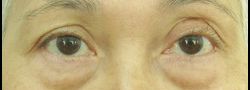 Dr. Lee’s Brow Lift case #10649
