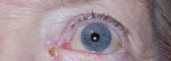 Eyelid Reconstruction case #10706