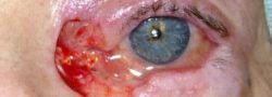 Eyelid Reconstruction case #10706