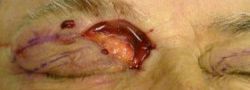 Eyelid Reconstruction case #10700