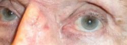 Eyelid Reconstruction case #10691