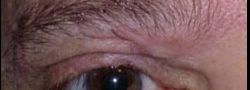 Eyelid Reconstruction case #10688