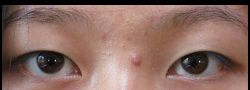 Asian Crease & Double Eyelid Surgery case #10538