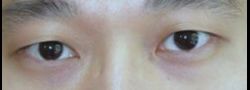 Asian Crease & Double Eyelid Surgery case #10544