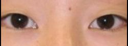Asian Crease & Double Eyelid Surgery case #10547