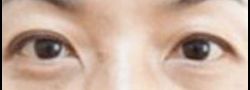 Asian Crease & Double Eyelid Surgery case #10550