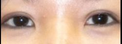 Asian Crease & Double Eyelid Surgery case #10553