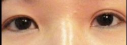 Asian Crease & Double Eyelid Surgery case #10553