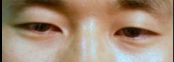 Asian Crease & Double Eyelid Surgery case #10556