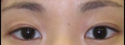 Asian Crease & Double Eyelid Surgery case #10560