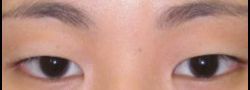 Asian Crease & Double Eyelid Surgery case #10560